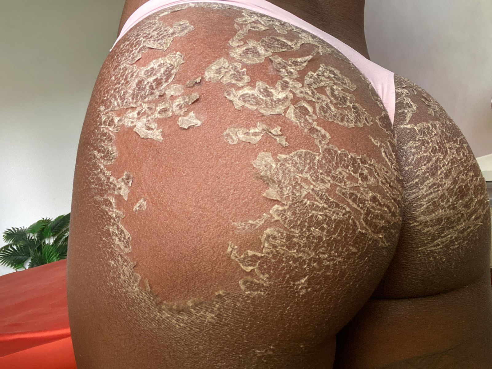 Fase descamacao - Gluteo intenso