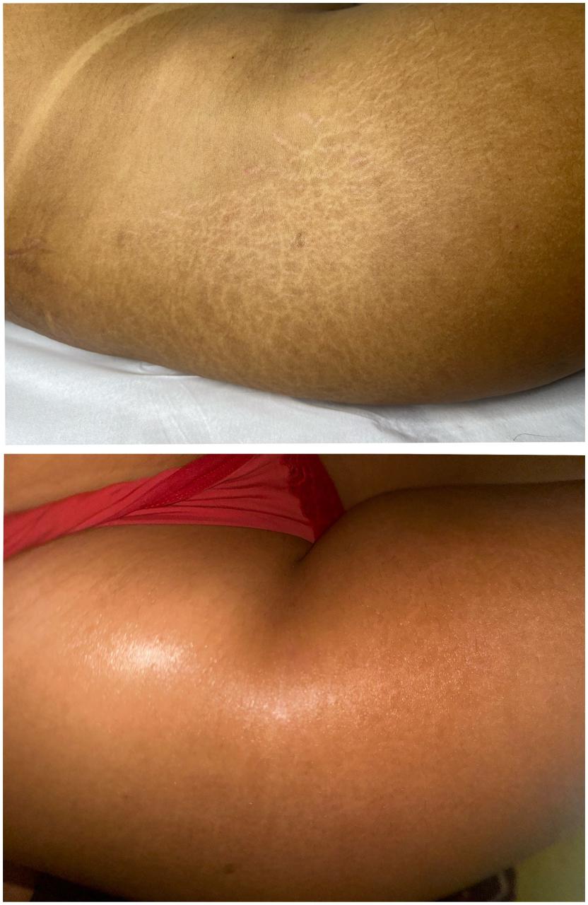 Micropuntura de estrias - Quadril antes e depois
