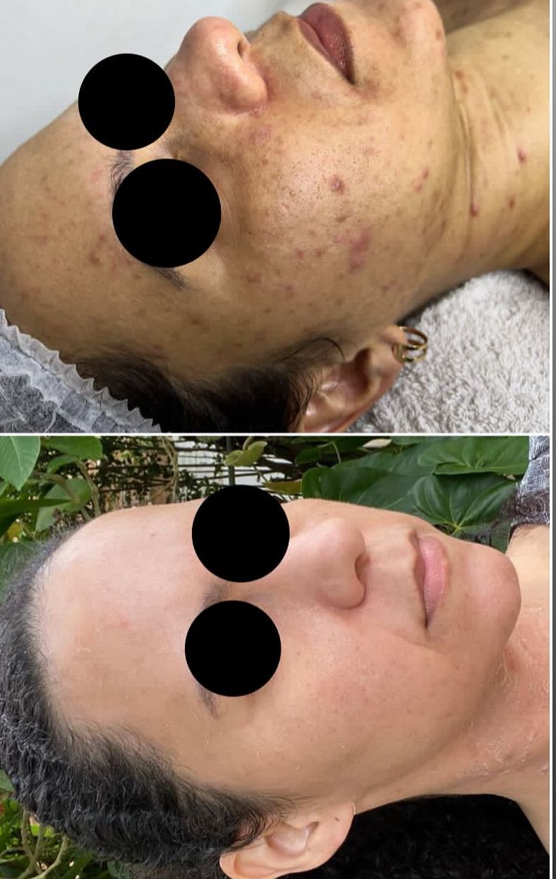 Resultado facial - antes e depois acne