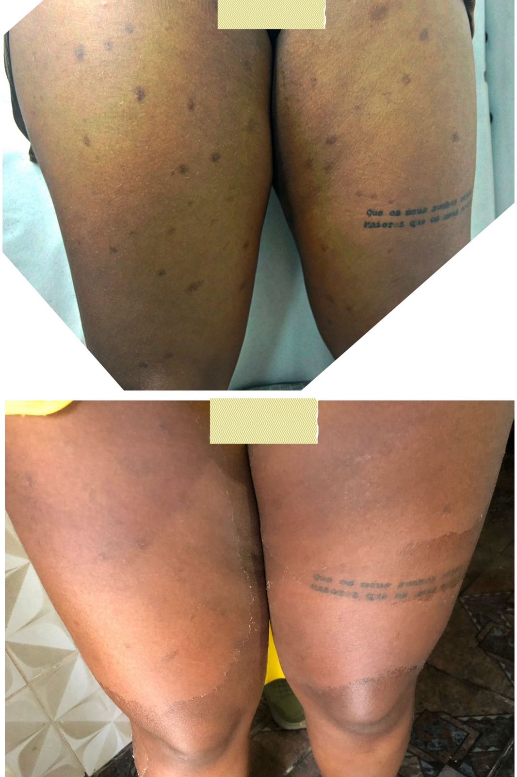 Resultado coxas - antes e depois foliculite