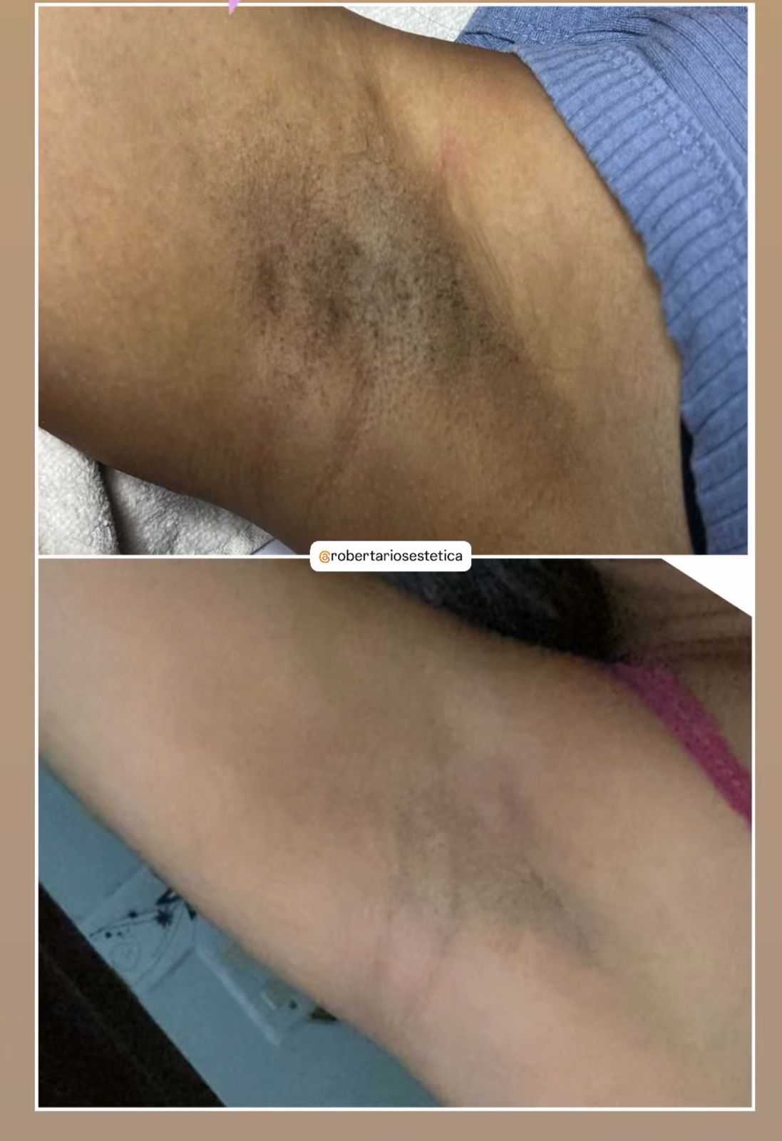 Resultado axila - antes e depois escurecimento