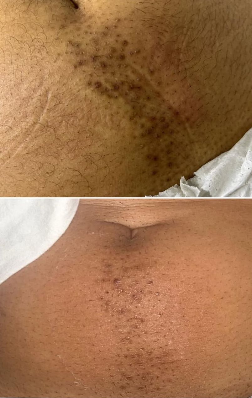 Resultado virilha - antes e depois foliculite