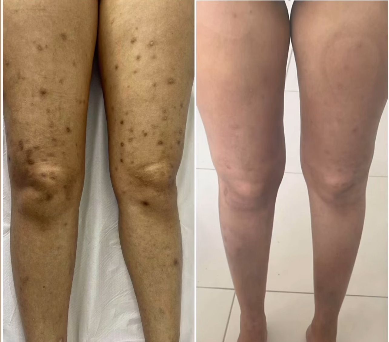 Resultado pernas - antes e depois foliculite