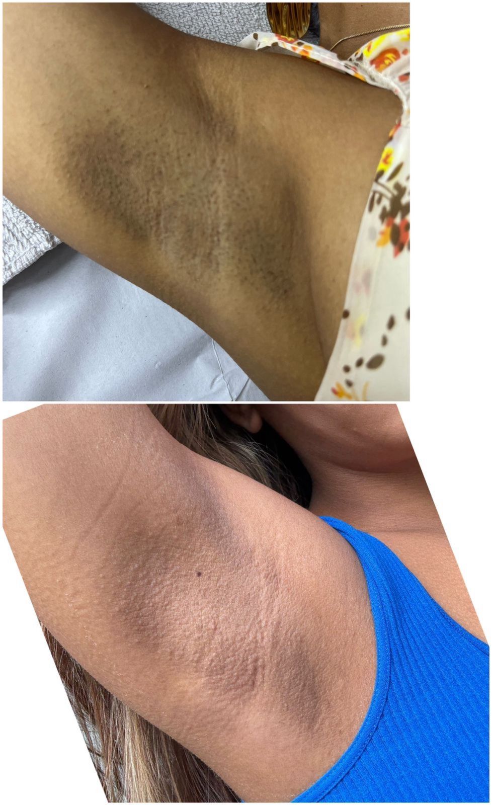 Resultado axila - clareamento