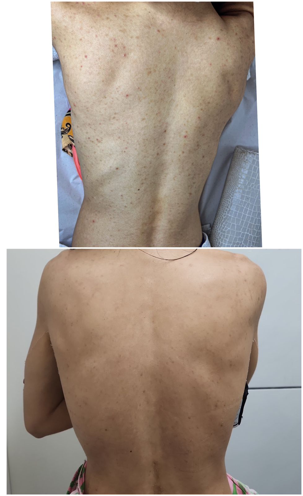 Resultado costas - foliculite tratada