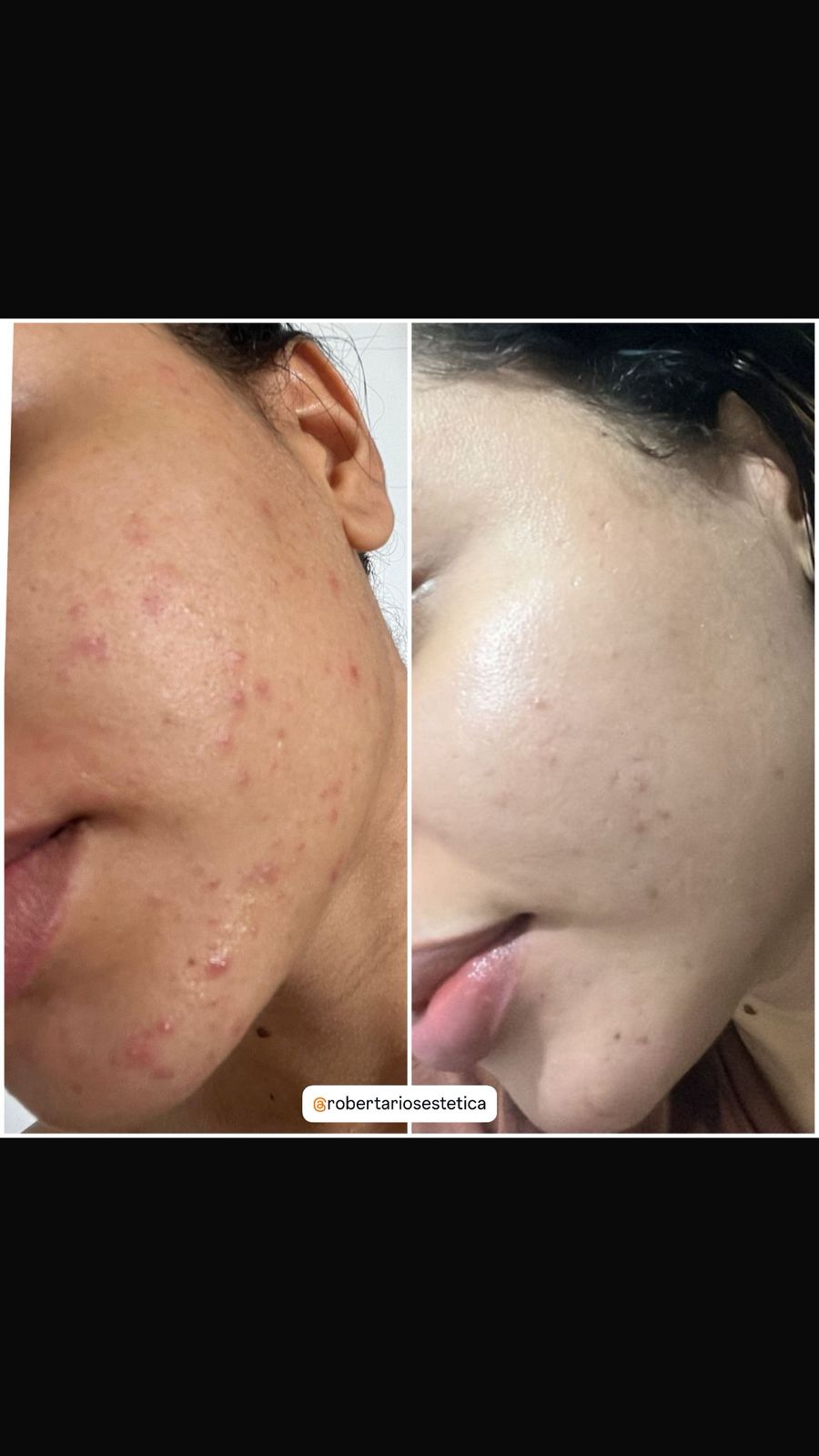 Resultado facial acne - antes e depois