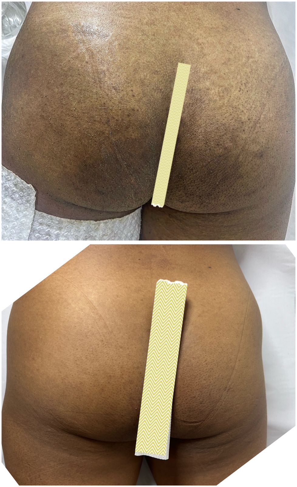 Resultado gluteo - foliculite intensa